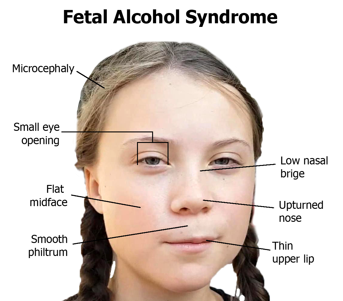 Image result for greta thunberg alcohol fetal